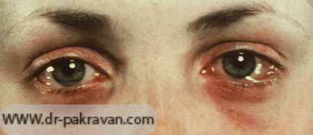 آلرژی در چشمها