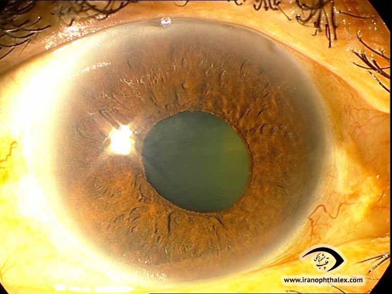 Neovascularization of iris